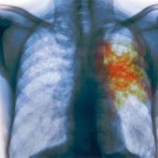 Уровень заболеваемости туберкулезом на Херсонщине в 1,5 раза выше чем по Украине