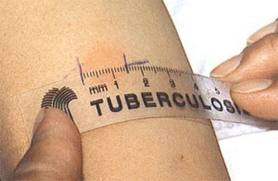 Уровень заболеваемости туберкулезом на Херсонщине снижается
