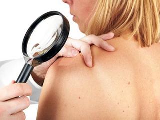 Херсонцы смогут бесплатно диагностироваться на рак кожи