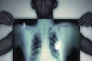 В Каховке появился больной открытой формой туберкулеза. который намеренно заражает окружающих