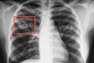 Показатель заболеваемости туберкулезом в Херсоне снизился почти на 5%