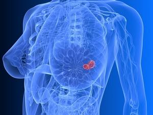 У каждой пятой херсонки диагностируют рак молочной железы