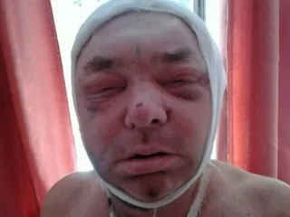 “Забивали их приблизительно больше часа, количество нападающих было 8-11 человек”: подробности избиения участника АТО на Херсонщине