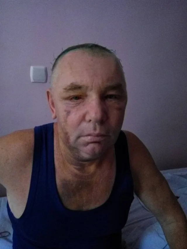 На избитого турками ветерана АТО оказывают давление прямо в больнице